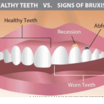 Grinded Teeth Repair