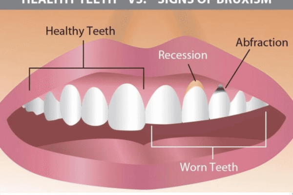 Grinded Teeth Repair
