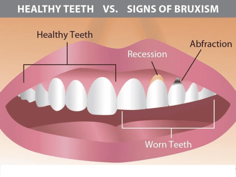Grinded Teeth Repair