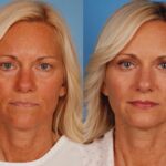 lid surgery before and after