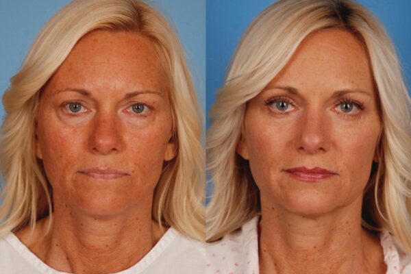 lid surgery before and after