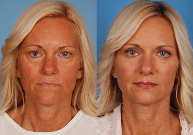 lid surgery before and after